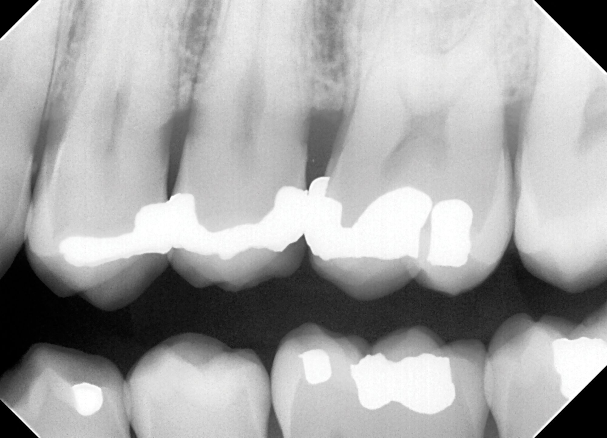 How to Repair Amalgam Restorations With Recurrent Caries